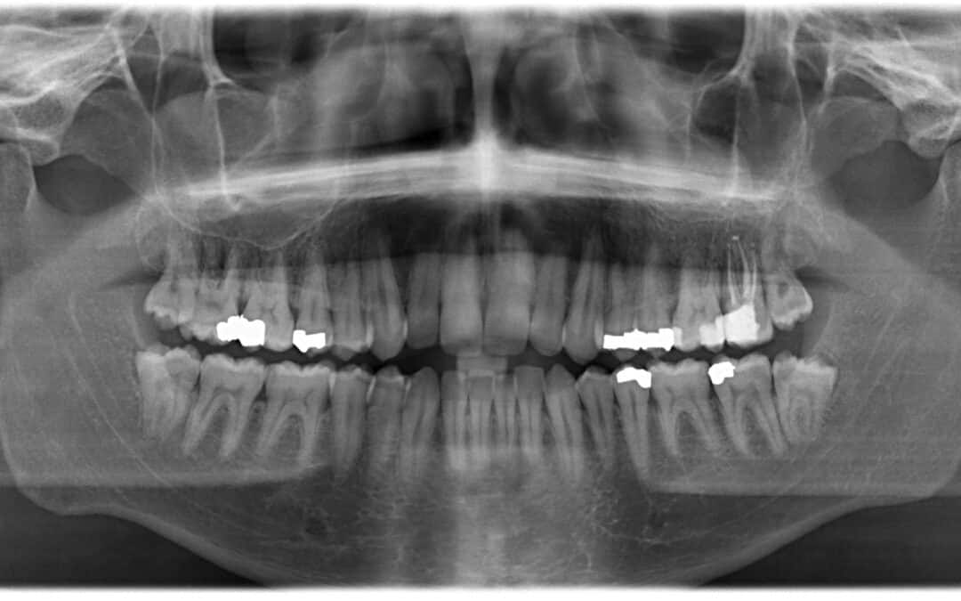 Root Canal Theory – Nov 15