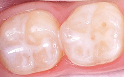 Skygate_Dental_Fissure_Sealant Fissure Sealant