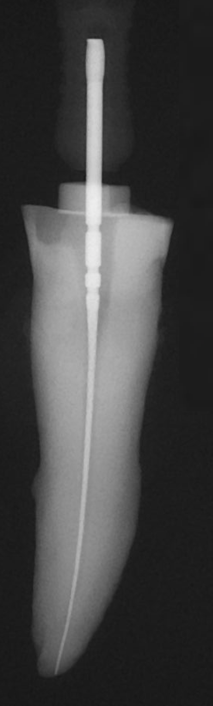 Why do a Root Canal Filling?