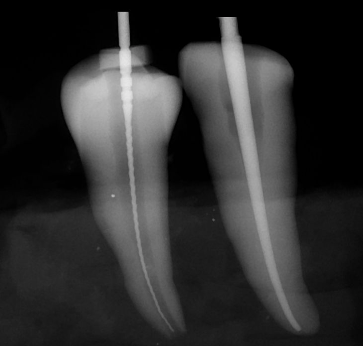 Root Canal Filling? 1 Skygate Dental Root Canal Filling