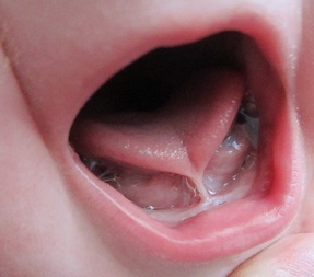 Tongue Tie