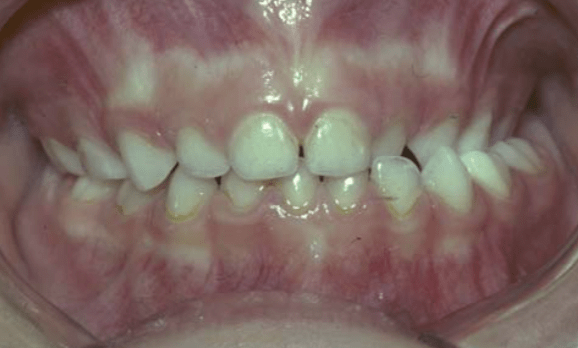Orthodontics: Cross-Bite Orthodontics: Cross-Bite