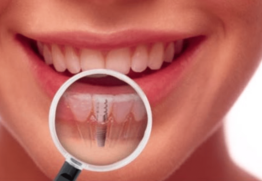 Dental Implant Integration 1 Dental Implant Integration