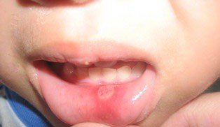 Ouch! Mouth Ulcer 1 Skygate Dental Mouth Ulceration