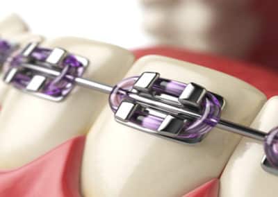 Traditional Metal Braces