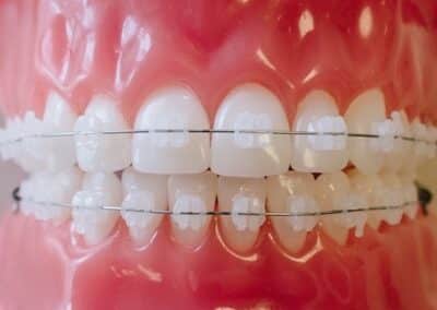 Ceramic Braces