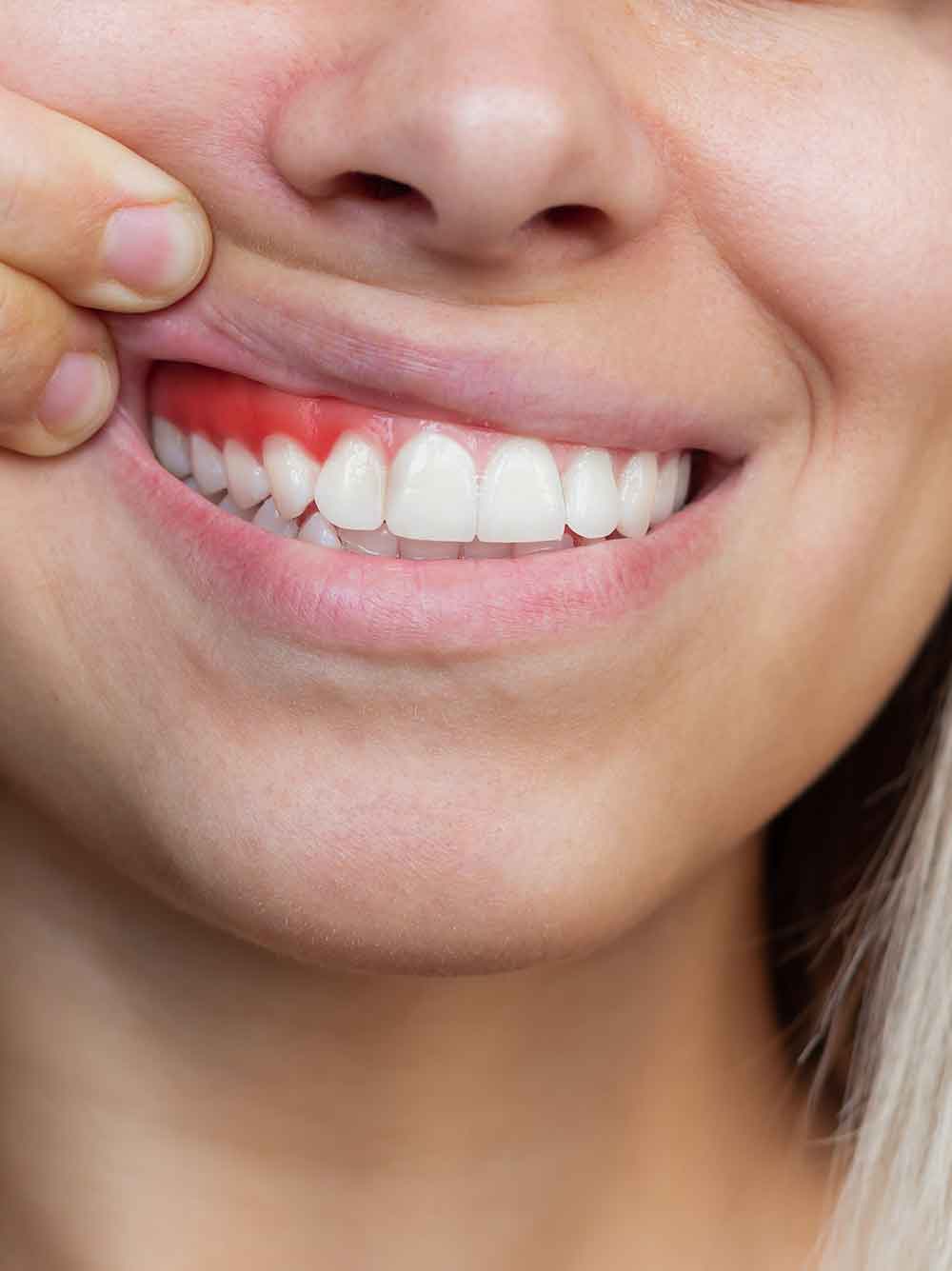 gum inflammation closeup young woman showing bleeding gums gray background dentistry