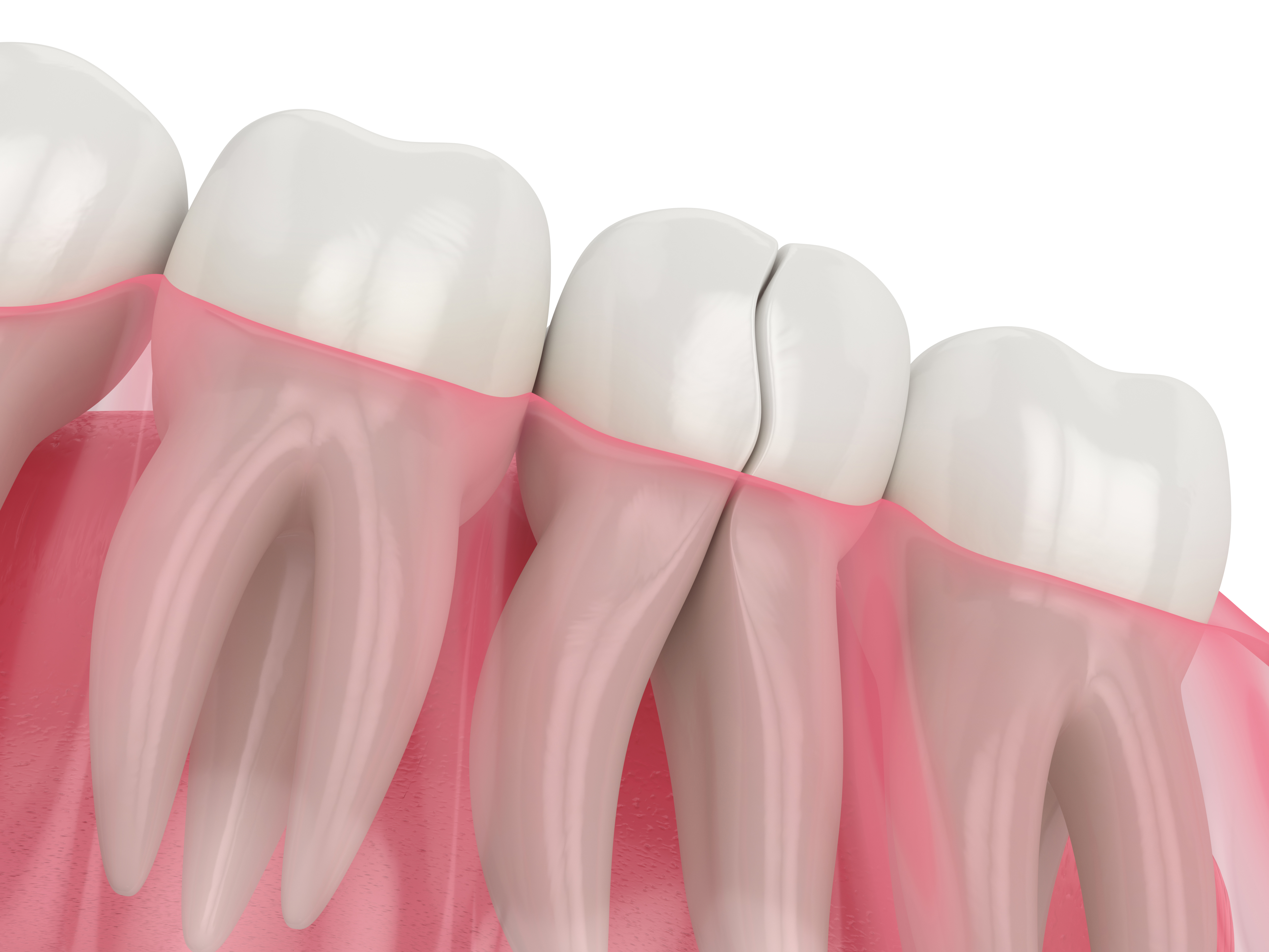 3d render of jaw with cracked tooth 1205919697