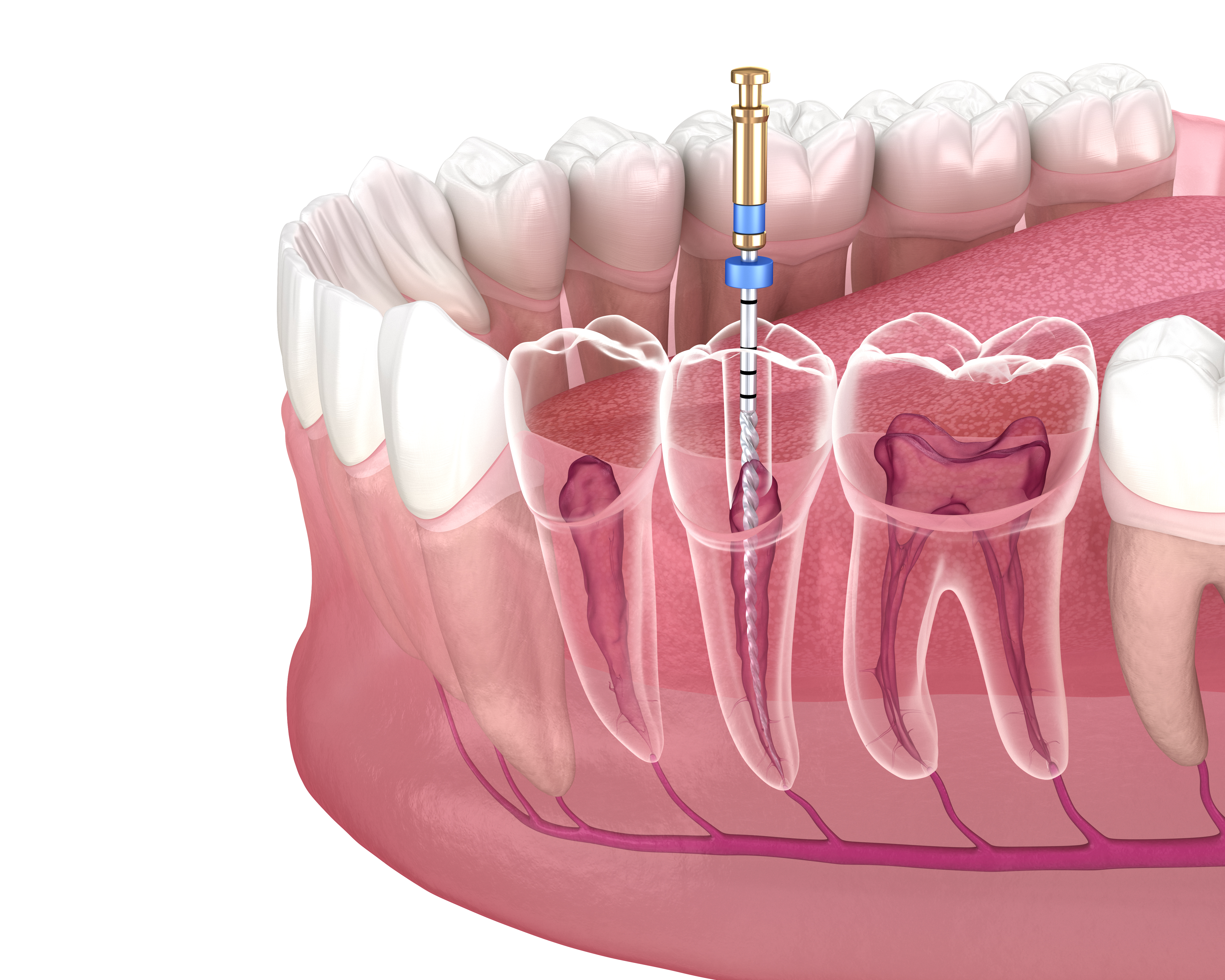 Endodontic root canal treatment process. Medically accurate tooth 3D illustration. 1269231046