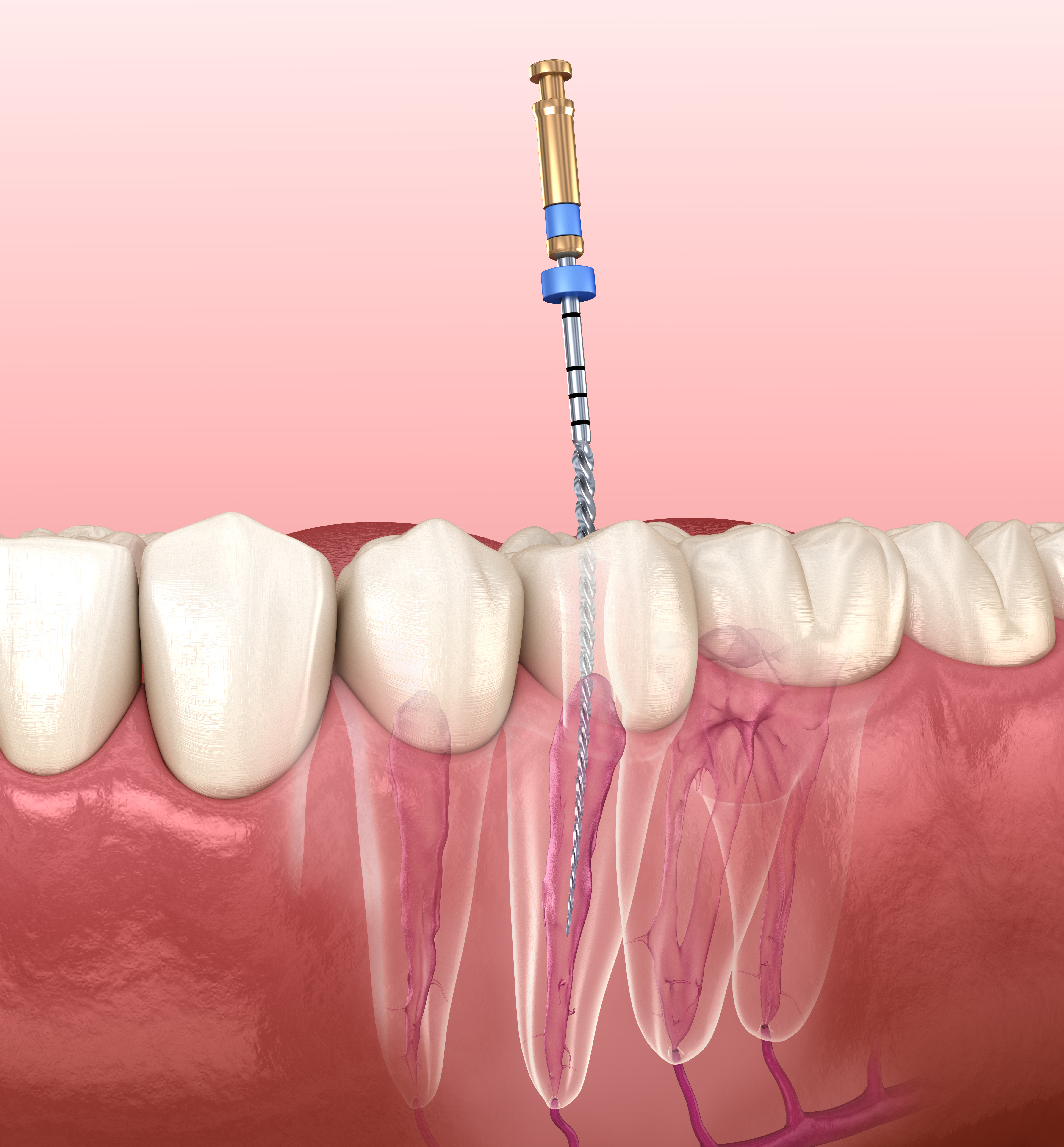 Endodontic root canal treatment process. Medically accurate tooth 3D illustration. 1345444989