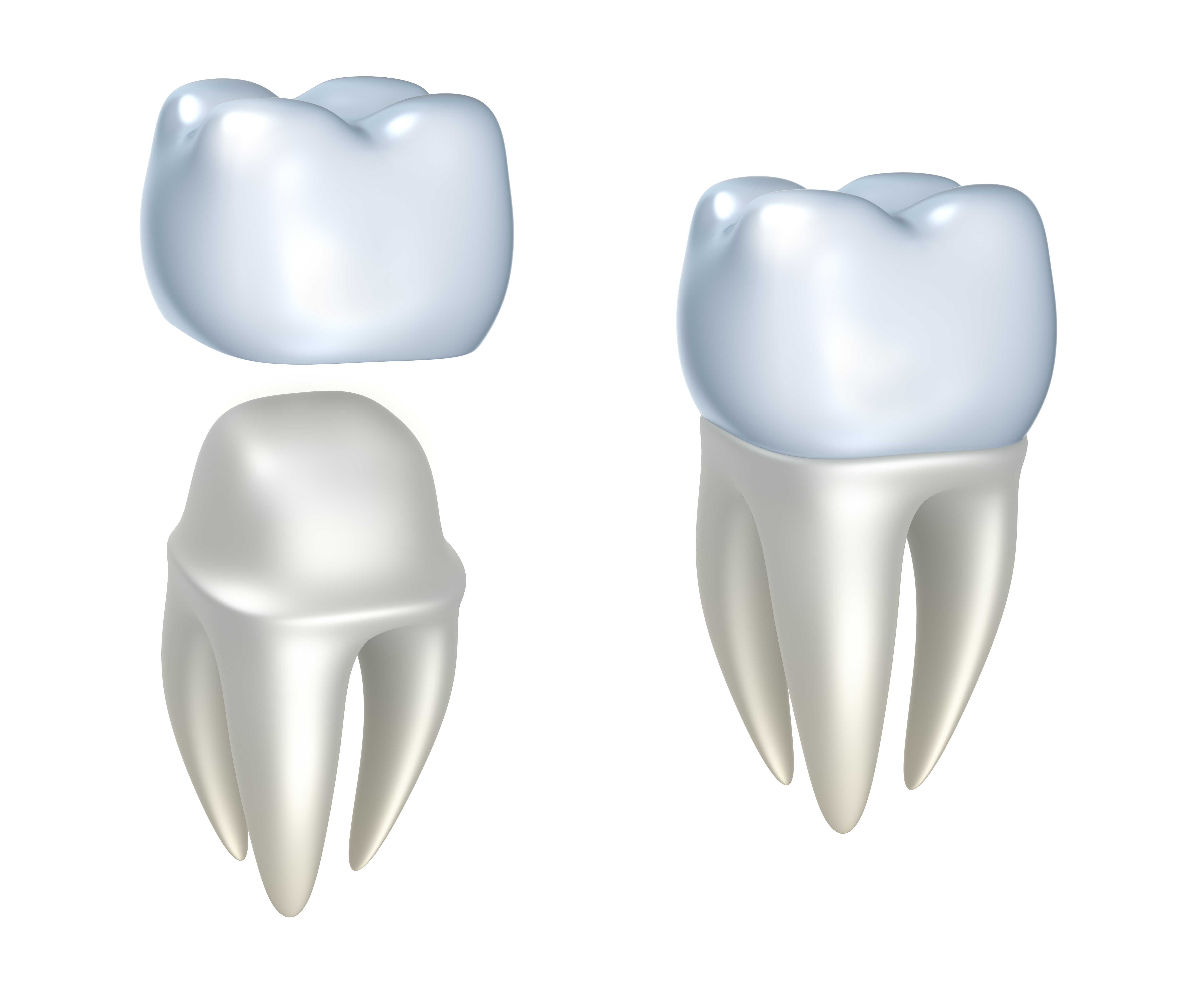 Sequential images of dental crowns and tooth 148797914