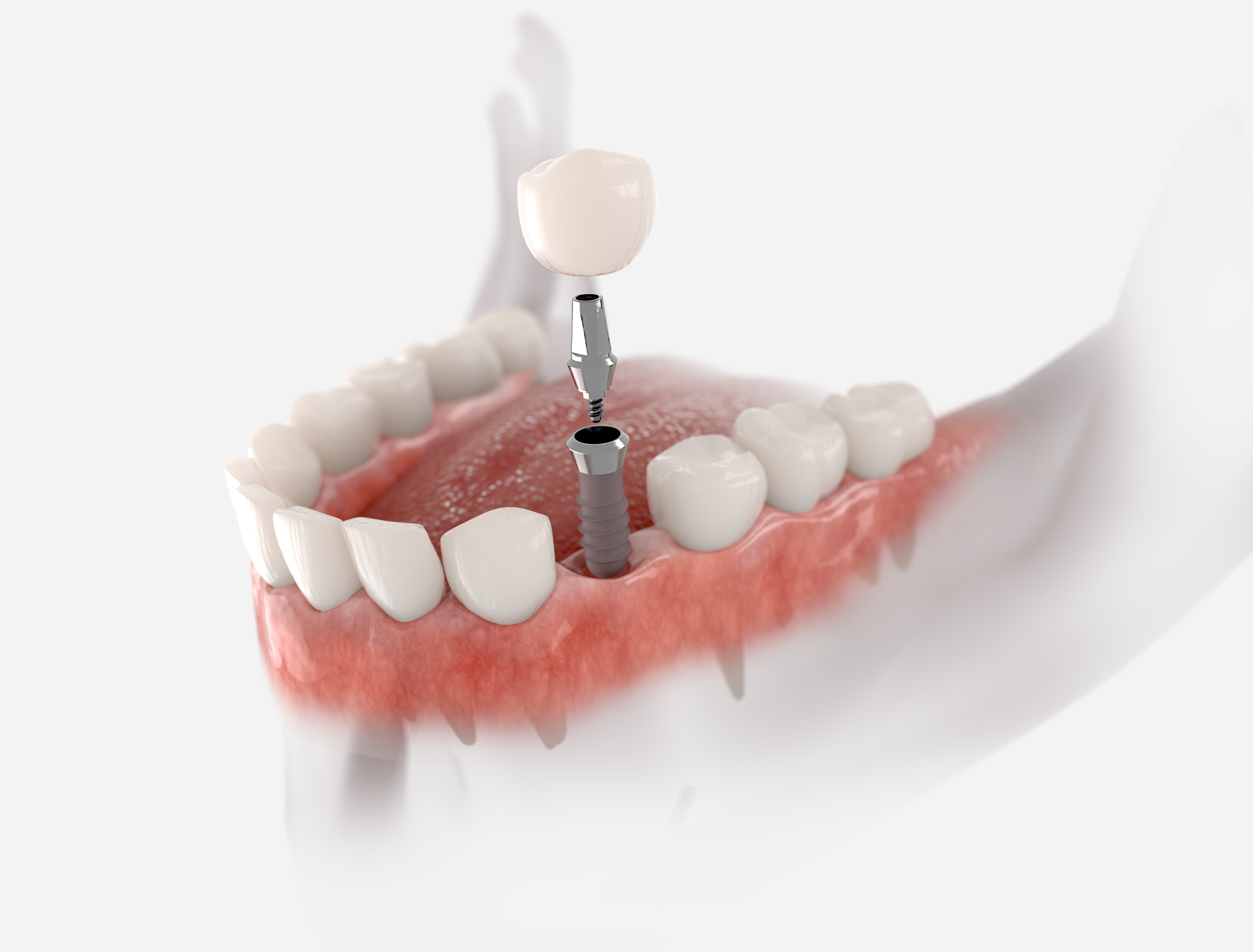 Premolar tooth implant iStock 1273348220
